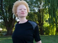 albinism_thumb.jpg